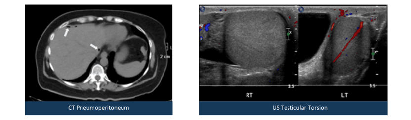 CT Pneumoperitoneum-1