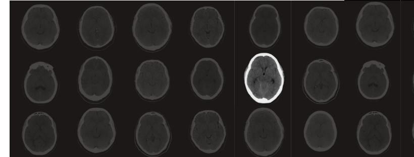 AI in Radiology: Making an Impact Today and Charting a Path to the Future
