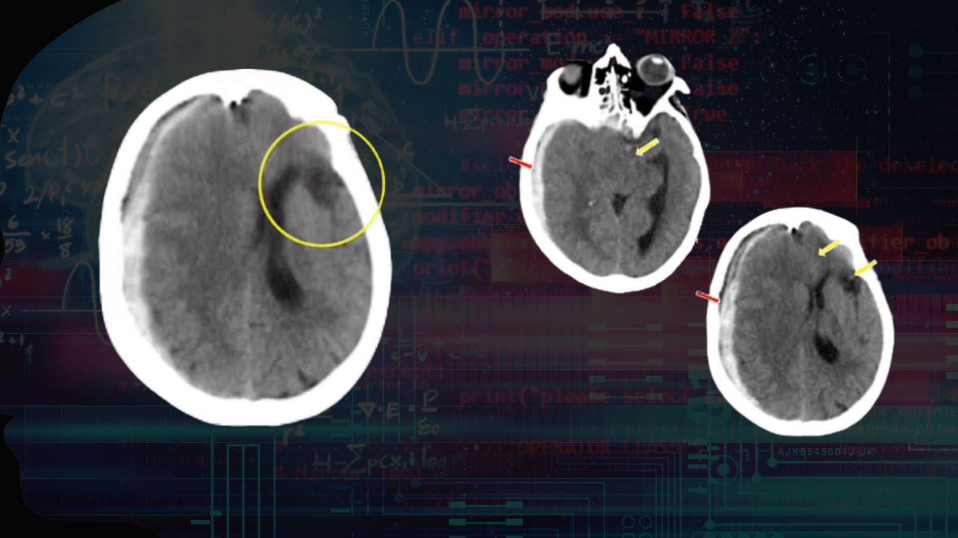 I See AI Improving Care for Stroke Victims Every Day