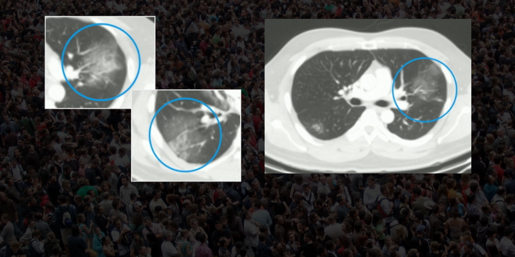 These CT Images Lead to Diagnosis of One of the First COVID-19 Patients in the U.S.